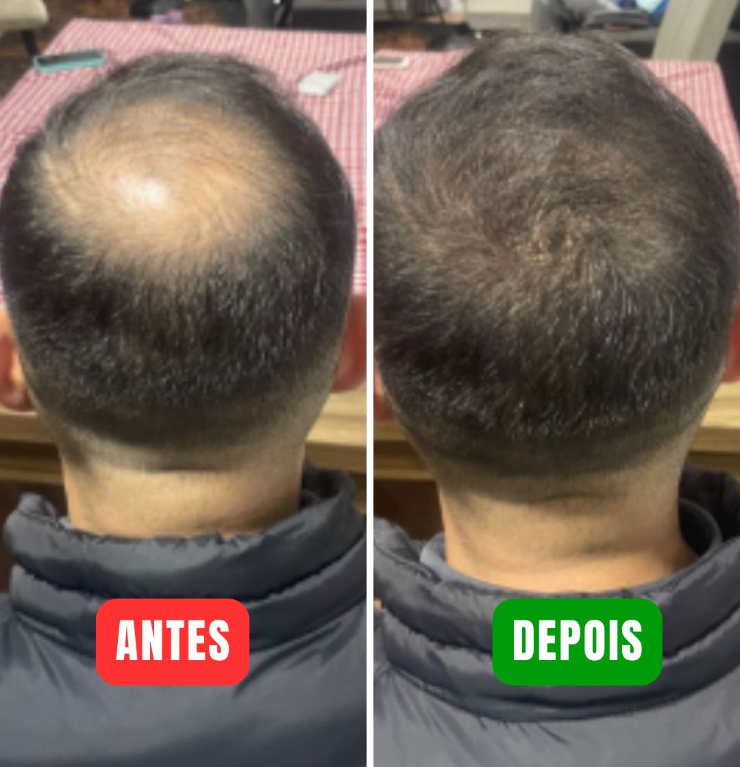 Magic Colour - Elimine a calvície em minutos! (Compre 1 Ganhe 2)